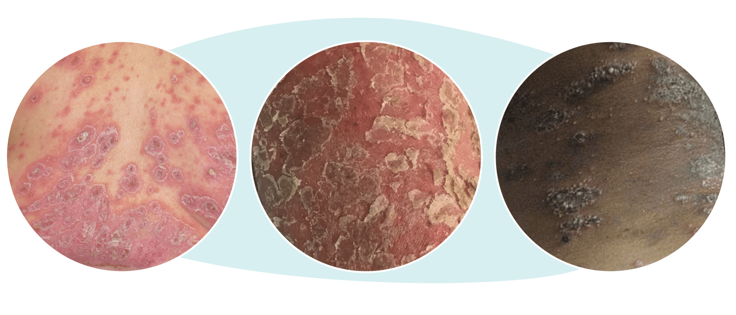 Three examples of GPP symptoms with red, scaly, or discolored skin in different skin tones