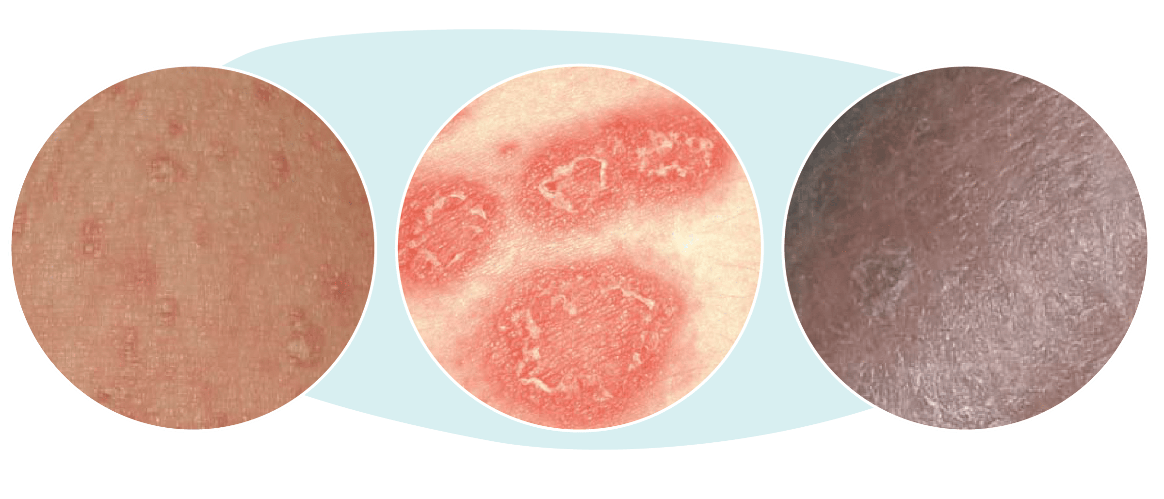 Examples of skin affected by GPP, showing redness, blisters, and scaling between flares